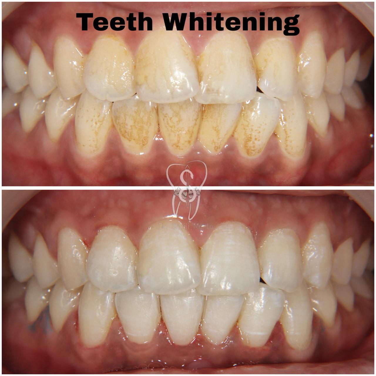 Teeth Whitening